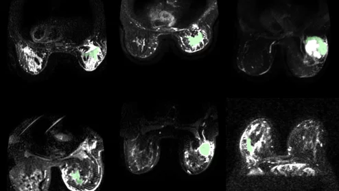 CDI technique makes breast cancer glow on imaging.