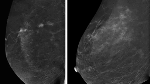 BPE on contrast-enhanced mammograms.