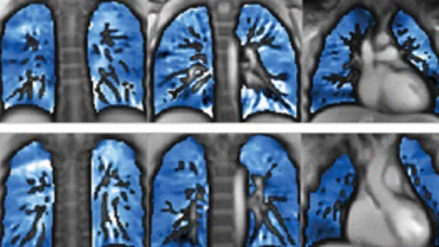 Children show signs of post-COVID lung damage on MRI.