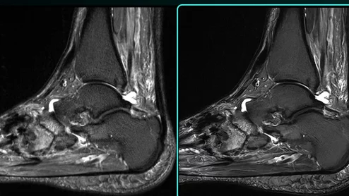 SubtleHD receives FDA clearance for AI-powered MRI solutions