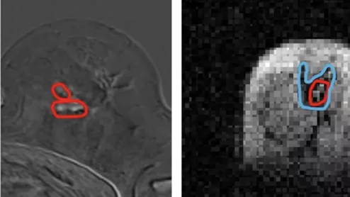 FCI scanner more ably detects cancer spread than traditional MRI
