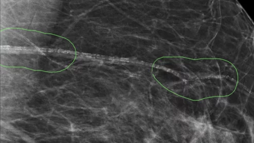 AI not currently safe to use as a standalone reader in breast cancer screenings.