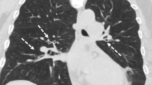 Marijuana may cause less lung damage than cigarettes