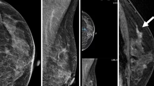 AI spots contralateral cancer post-mastectomy