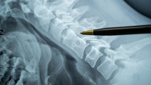 Spine X-ray spinal cord
