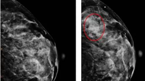 Experts use radiomics features to spot specific tissue patterns related to breast cancer.