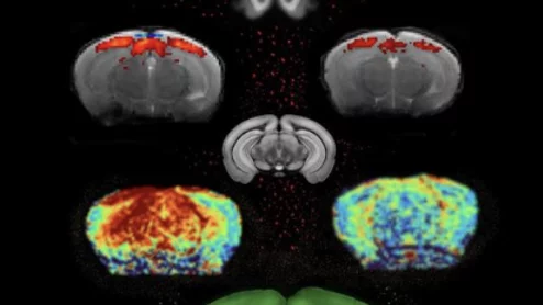 MRI biomarkers could signal early onset of Parkinson's.