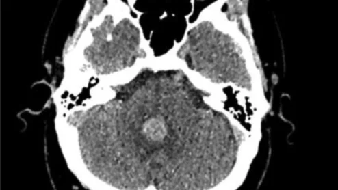 MRI may not be suitable for spontaneous deep ICH