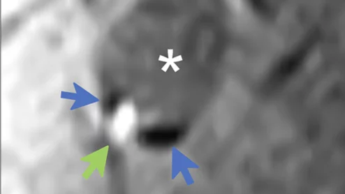 Calcified carotid plaques more likely to rupture than previously believed