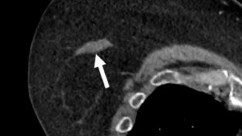 AI detects incidental breast lesions on routine CT scans