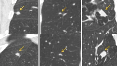 AI model reduces false positives on lung cancer CT scans