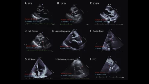 Cardiologists have developed an open-source artificial intelligence (AI) model capable of accurately evaluating a long list of measurements on echocardiography results. The group detailed the development and validation of that model in the Journal of the American College of Cardiology.