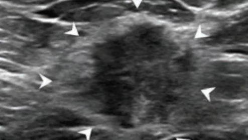 Echogenic rinds on ultrasound may signal invasive cancer.