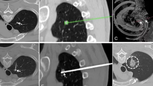 Robotic-assisted RFAs yield better outcomes during lung tumor ablations