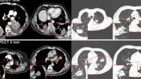 Photon-counting CT scans best conventional CTs for lung cancer follow-up