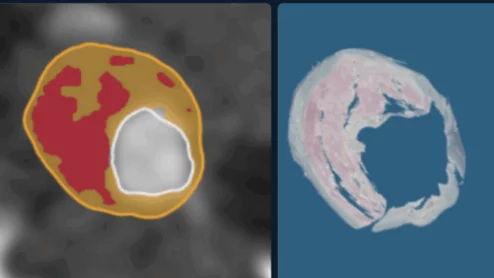 Elucid's new Lesion Analysis Tool now commercially available