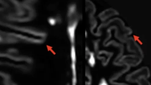 AI helps spot invisible gray matter MS lesions
