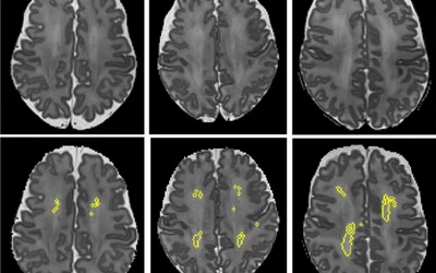 Brain MRI. MRI scans showing diffuse white-matter abnormality. The top three panels display raw MRI images from very preterm infants born at 27 weeks (left), 26 weeks (center), and 31 weeks (right) of gestation. Higher signal intensity can be seen in the central white matter, particularly for the 31-week-gestation infant. The bottom panels display the corresponding slices with objectively segmented DWMA in yellow. The 27-week infant (left) was diagnosed with mild DWMA. Cincinnati Children's