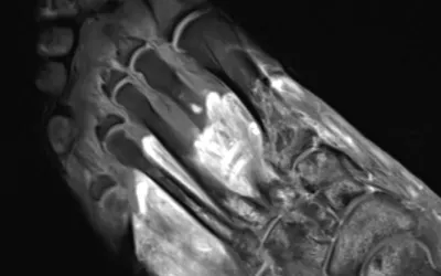 MRI of the foot in a patient with severe COVID-19. The grey part of the foot is gangrene. The 57-year-old male with prolonged hospitalization for COVID-19 and multi-organ failure was imaged at Northwestern Medicine in Chicago. The post-contrast, T1-weighted fat saturated image demonstrates soft tissue enhancement of the proximal foot (dashed arrow) with non-enhancing devitalized tissue distally (gray tissue by toes), compatible with gangrene. Multifocal bone marrow edema pattern. COVID toe image.