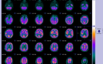 Fludeoxyglucose F18 (FDG) radiotracer positron-emitting tomography (PET-CT) imaging of the brain. Brain cells consume the sugar attached to this radiotracer allowing the radioactive material to concentrate in areas of cell metabolism. The colors show areas of high and low metabolic activity in the brain and can be used to diagnose several conditions. Cancers have very high metabolic activity so will appear as bright spots in this type of imaging. PET brain scan.