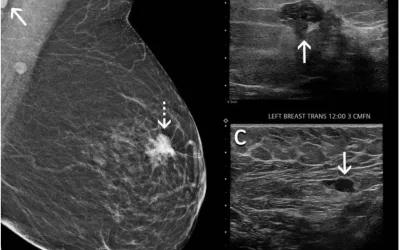 Don't delay mammograms after COVID vaccine. Women do not need to delay their mammogram appointment after COVID-19 vaccination. A new study suggests not delaying mammograms due to getting a COVID vaccine because cancers may go un detected. The RSNA study showed several examples of swollen lymph nodes that appeared to be from the vaccine, but turned out to be cancers. Women should not delay getting mammograms after COVID vaccines. Do not delay getting a mammogram with the COVID Vaccine. 