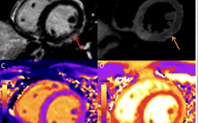 COVID-19 vaccine associated myocarditis on short-axis 1.5T MRI images of a 19-year-old man who presented with chest pain three days following the second dose of an mRNA COVID-19 vaccine. Clinical imaging presentations of COVID. Clinical images of COVID. Medical imaging of COVID-19, SARS-CoV-2. What dose COVID look like on medical imaging?