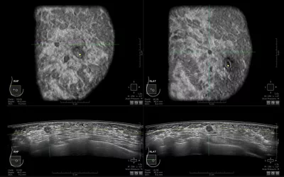 Example of an automated breast ultrasound (ABUS) exam showing ductal carcinoma. ABUS systems enable consistent, high quality breast ultrasound scans that help eliminate the variability in image quality and imaging technique between various sonographers. ABUS also helps in clinics where they might not have a highly experienced sonographer. Consistent scans are needed to track tumor size and landmarks in imaging for serial screenings and during What does ABUS look like? What is an automated breast ultrasound?