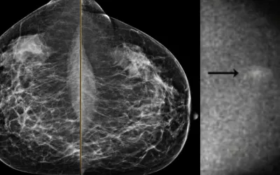 An example of a mammogram with some dense breast tissue that was deemed to not have cancer, and molecular breast imaging (MBI) study of the same women showing increased metabolic activity in the dense area, revealing a caner. Image from Mayo Clinic.