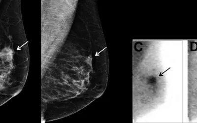 Mammography images (left) compared to molecular breast imaging (MBI) monitoring of tumor response to chemotherapy. Image from SNMMI.