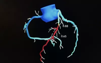 Performing CT-derived fractional flow reserve (CT-FFR) before transcatheter aortic valve replacement (TAVR) improves the accuracy of coronary CT angiography (CCTA) and helps limit unneeded invasive coronary angiography (ICA), according to a new study published in JACC: Cardiovascular Interventions. Heartflow