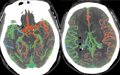 Ischemic stroke CT scan showing color coded blood flow for early and later arterial and venous contrast phases and areas of blocked blood flow. Image courtesy of RSNA