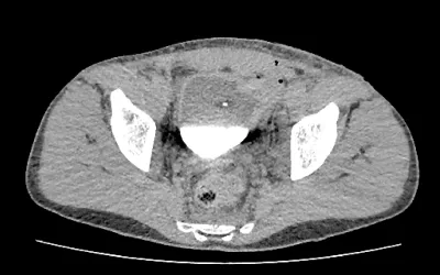 Bone fragment inside the bladder on CT. It broke off when a section of the pelvis shattered from the impact of penetrating shrapnel fraveling down from the abdomen. The fragment was hit with enough force to penetrate the bladder.  Laporotomy performed, resulting in bowel resection and bladder stoma. Image from Odrex Hospital, Odesa.
