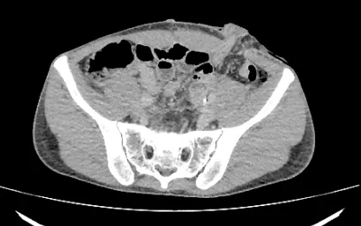 CT showing the entry wound of shrapnel into the abdomen and into the large intestine bone. The metal fragments traveled deeper and fractured the patient's pelvis. Image from Odrex Hospital, Odesa.