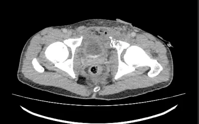 CT scan showing shattered portion of pelvis struck by shrapnel that penetrated the abdomen and bowl above it. This is a foreign soldier who volunteered to fight for Ukraine, wounded in combat at Nikolayv. Multiple fragments of shrapnel penetrated the abdomen and fractured the pelvis. Laporotomy performed, resulting in bowel resection and bladder stoma. Image from Odrex Hospital, Odesa.