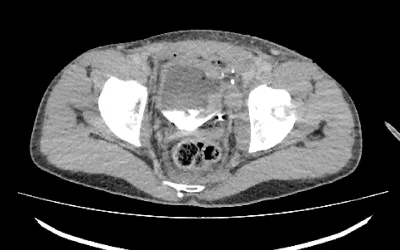 CT showing bone fragments the traveled deeper into the issue from the impact of shrapnel that shattered a portion of the pelvis near the bladder. Image from Odrex Hospital, Odesa.