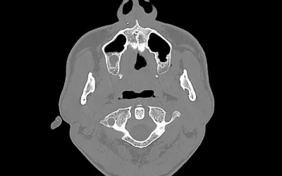 Head CT showing shrapnel fragment embedded under the patient's nose. At least 5 small superficial shrapnel fragments where identified in a head CT scan, which was performed to assess the location of the metal fragments and if there was any internal damage. Image from Odrex Hospital, Odesa. #StandwithUkraine #Ukraineradiology