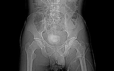 Scout CT scan of pelvis and abdomen showing small pieces of shrapnel fragments. This is a foreign soldier who volunteered to fight for Ukraine, wounded in combat at Nikolayv. Multiple fragments of shrapnel penetrated the abdomen, bowl, bladder and fractured the pelvis. #WarinUkraine #StandwithUkraine