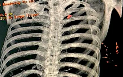 A 3D CT image reconstruction showing a Russian bullet in a civilian patient's upper lung lobe. The entry point and track of the bullet can be seen can be seen on the right of the image, marked by a series of metal fragments. The patient was being treated at the Heart Institute in Kyiv after he tried to drive his family out of the area of the front lines and was shot by Russian soldiers. Photo by Igor Mokryk, MD.