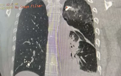 A CT image from the Heart Institute in Kyiv, showing a Russian bullet in a civilian patient's upper lung lobe. The patient was being treated at the cardiology hospital after he tried to drive his family out of the area of the front lines and was shot by Russian soldiers.  Photo by Igor Mokryk, MD.