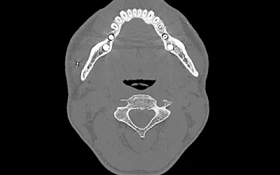 Head CT showing two superficial shrapnel fragments in the patient's jaw. At least 5 small superficial shrapnel fragments identified in a head CT scan, which was performed to assess the location of the metal fragments and if there was any internal damage. Image from Odrex Hospital, Odesa. #UkraineWar #Ukraineradiology