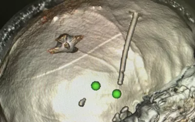 Ultrasound guidance was used to retrieve a shrapnel fragment located in between the hemispheres of the brain after entering the front temple in 13-year-old female civilian from Russian rocket artillery in Ukraine. Ohmatdyt children's hospital in Kyiv removed the fragment. See more clinical images of the Ukraine-Russian war