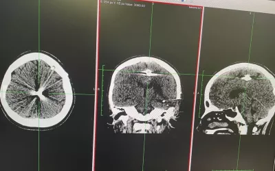 Brain CT scan showing shrapnel in between the hemispheres of the brain after entering fron front temple in Sofia, age 13, from the Mykolaiv region, located along the Black Sea coast between Kherson and Odesa. She was struck in the head by shrapnel from a Russian rocket artillery bombardment of her village March 5. Moved to Ohmatdyt children's hospital in Kyiv March 29 to remove the fragment. The shrapnel. Trepanation of the skull performed to removed the fragment with the help of ultrasound. #Ukrainewar