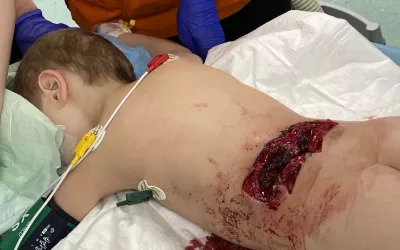 A 4-year-old boy with a severe shrapnel injury at the National Children's Specialized Hospital (Ohmatdyt) in Kyiv in early March 2022. He was struck by shrapnel from a Russian missile attack in a residential part of Kyiv. Ultrasound was used initially and then a CT workup found can the spinal cord and other internal organs were not affected. The imaging was used to help guide surgery to treat the wound and removed the non-viable tissues. His father was also wounded. #Ukraine