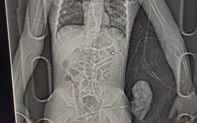 Digital X-ray of a boy from Kyiv area who was shot during the Russian advance on the city. Wounded on his side and neck and had a concussion. In the intensive care at Ohmatdyt pediatric hospital (https://ohmatdyt.com.ua/en/) intensive care unity in Kyiv Feb. 27, 2022. The military called an ambulance, and doctors performed an emergency surgery. #Standwithukraine #Ukarine #Ukrainewar