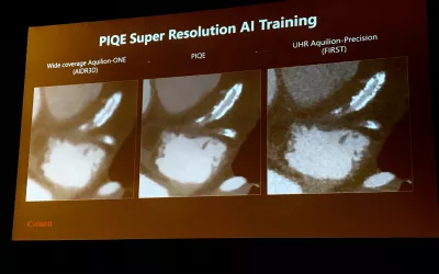 Example of an AI CT image reconstruction algorithm that can enhance imaging quality, reduce noise and reduce radiation dose, It also helps eliminate artifacts like metal and calcium blooming, as seen here, to see the lumen inside a coronary stent. This is Canon's second generation reconstruction AI, which was gained FDA in March 2024. #SCCT #SCCT2022 #yesCCT #cardiacCT