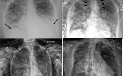 COVID ventilator complications due to barotrauma. Barotruama over 39 days: 56 year old female with RT-PCR confirmed COVID-19 and a history of ulcerative colitis intubated 1 day post admission. (A) Frontal chest radiograph on presentation demonstrates bilateral opacities (arrows) in a basilar predominant pattern, compatible with COVID-19 pneumonia. (B) Pneumomediastinum (arrowheads) and subcutaneous emphysema (arrows) developed 2 day post intubation. Image courtesy of Clinical Imaging. COVID presentations.