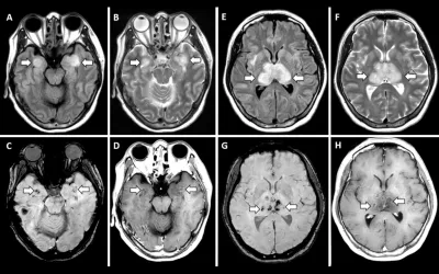 Acute necrotizing encephalopathy is a rare complication of influenza and other viral infections and has been related to intracranial cytokine storms, which result in blood-brain barrier breakdown but without direct viral invasion. Evidence suggests this also happens in severe COVID-19 cytokine storm syndrome, resulting in brain hemorrhages. RSNA image. CT of COVID. Images of COVID clinical presentations. What does COVID look like in the brain?. 
