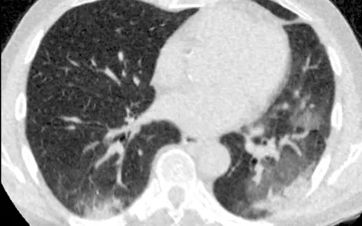 Example chest CT from a 69-year-old man with 7 days of symptoms. CO-RADS score of 5. Scan shows COVID pneumonia bilateral multifocal areas of ground-glass opacity (GGO) and consolidation in the vicinity of the visceral pleural surface. In addition, few thickened vessels in areas of ground glass are observed. Image courtesy of RSNA. CT of COVID. What does COVID look like in the lungs? Images of COVID clinical presentations.