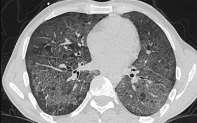 Lung CT of a 42-year-old man with more than 7 days of symptoms. Scans show COVID pneumonia with diffuse ground-glass opacities in close vicinity of visceral pleural surfaces. In addition, a crazy paving pattern is observed. Image courtesy of RSNA. Medical images of COVID. CT of COVID. What does COVID look like in the lungs? Images of COVID clinical presentations. #COVID #SARS-CoV-2