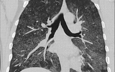 A typical view of a patient's lungs infected with COVID pneumonia, showing patchy, cloudy areas referred to as ground-glass opacities (GGO) caused by fluid and mucus build us inside the lung tissueLung CT of a 42-year-old man with more than 7 days of symptoms. Scans show COVID pneumonia with diffuse ground-glass opacities in close vicinity of visceral pleural surfaces. In addition, a crazy paving pattern is observed. Image courtesy of RSNA. Medical images of COVID. #COVID #SARS-CoV-2. Clinical imaging